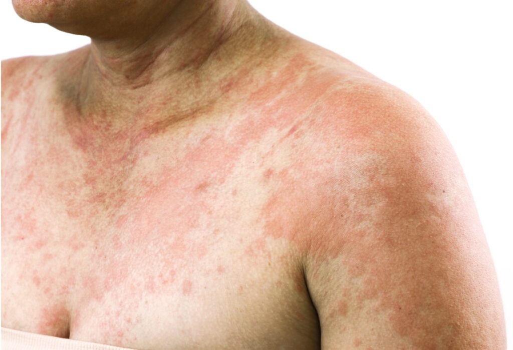 Anaphylaxis