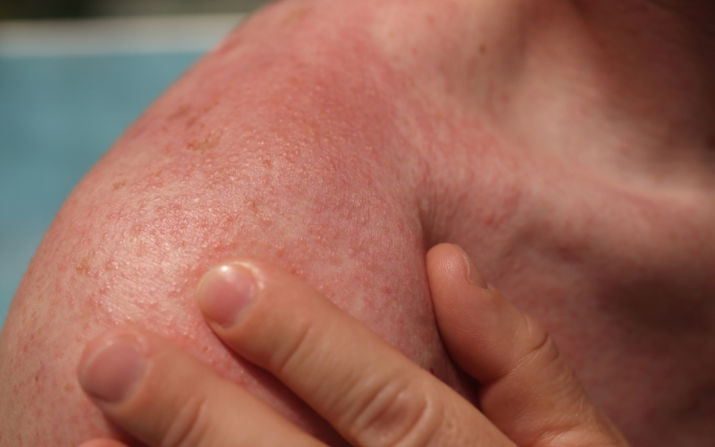 Solar Urticaria