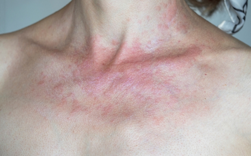 Sun allergy risk factors