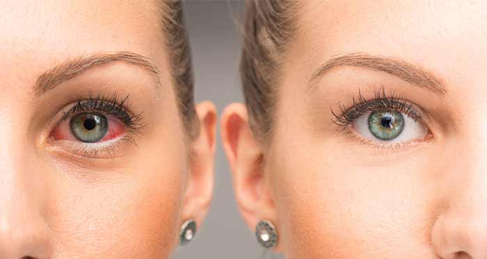 Seasonal eye allergies