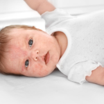 Allergy Toddler Rash