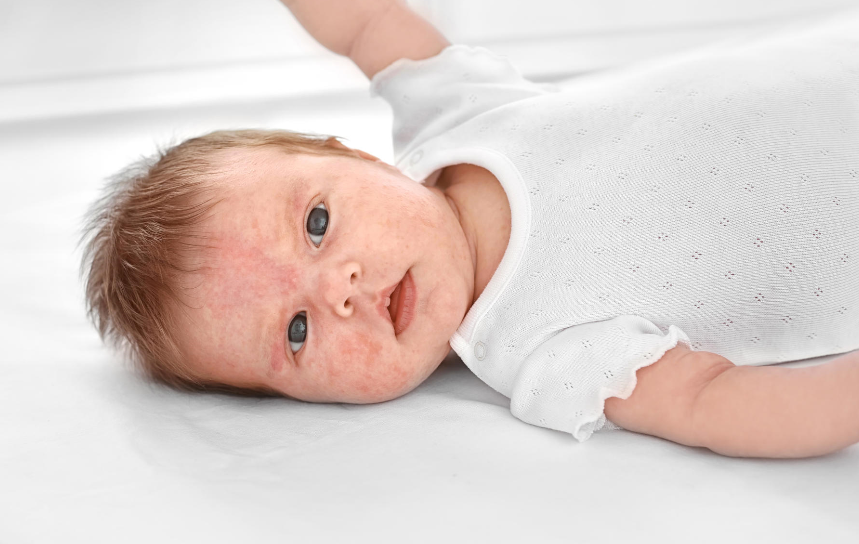 Allergy Toddler Rash