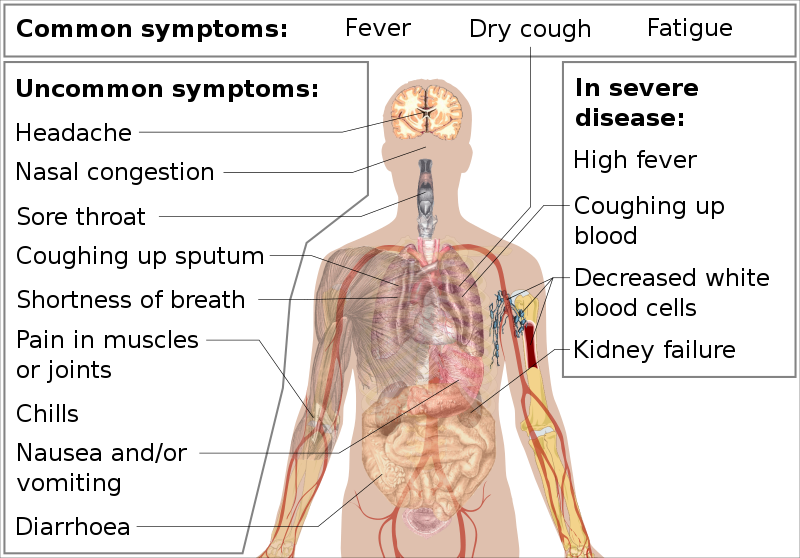 signs and symptoms-allergy tension fatigue syndrome
