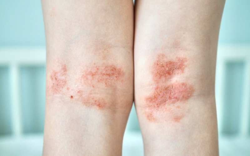 Eczema