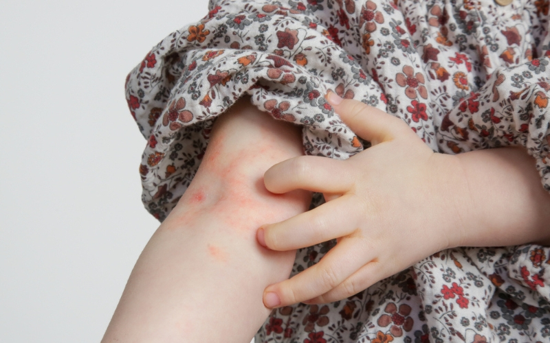 Rashes with itching
