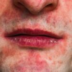 Rashes around the mouth