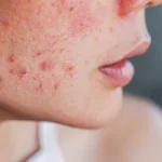 rashes