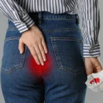Itchy Hemorrhoids