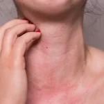Yeast Allergy