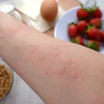 Strawberry Allergy Symptoms